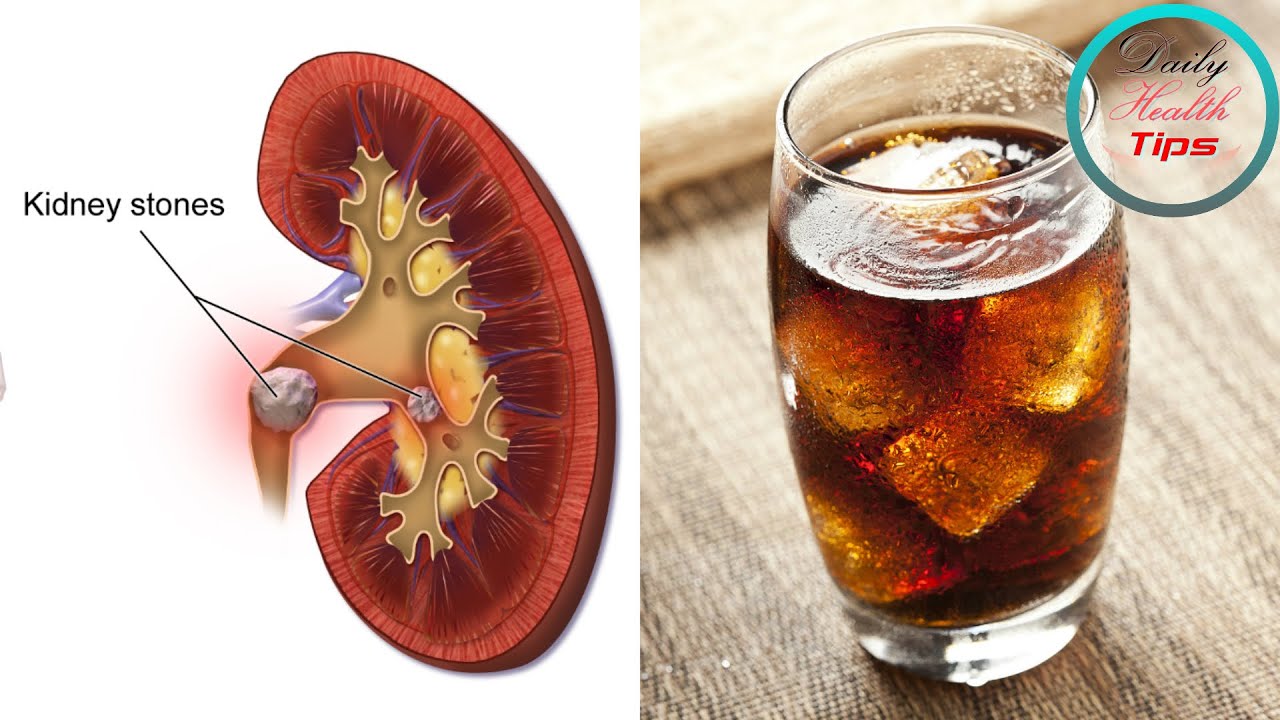 Foods That Can Cause Kidney Stone