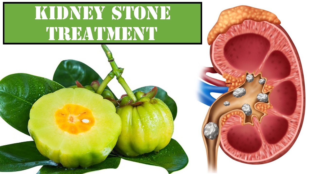 Foods To Eat During Kidney Stones