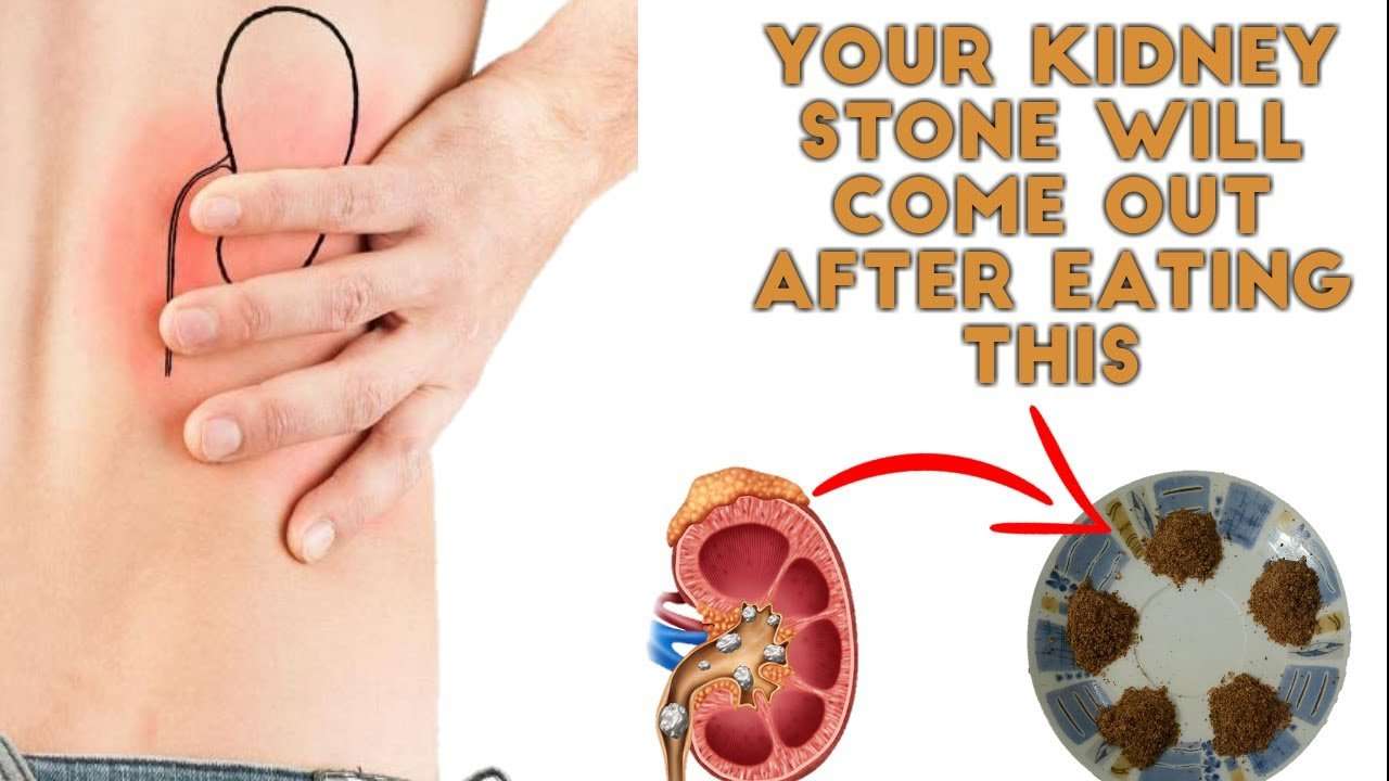 Get your kidney stone out through Urine Naturally