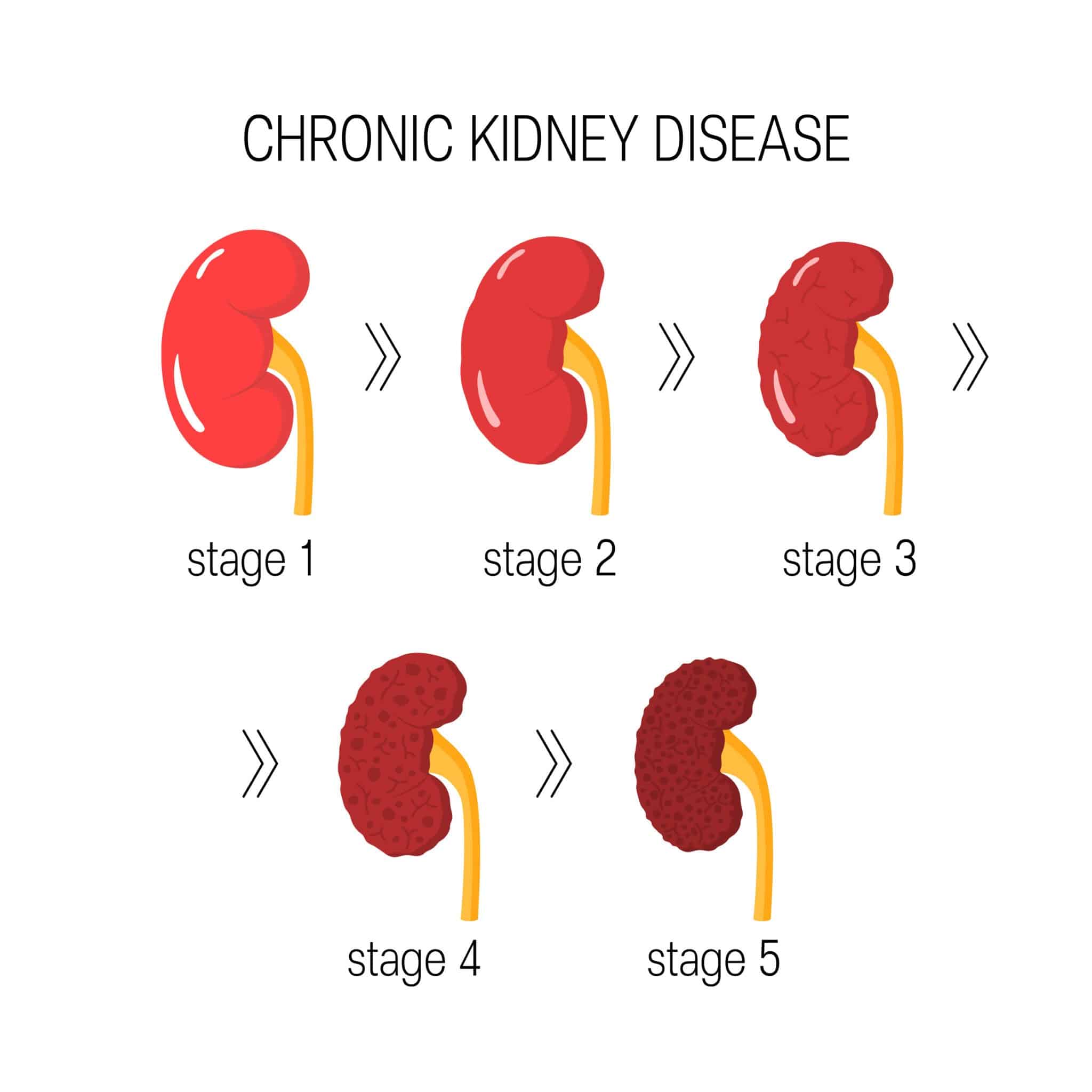 GFR And The 5 Stages Of CKD Made Simple