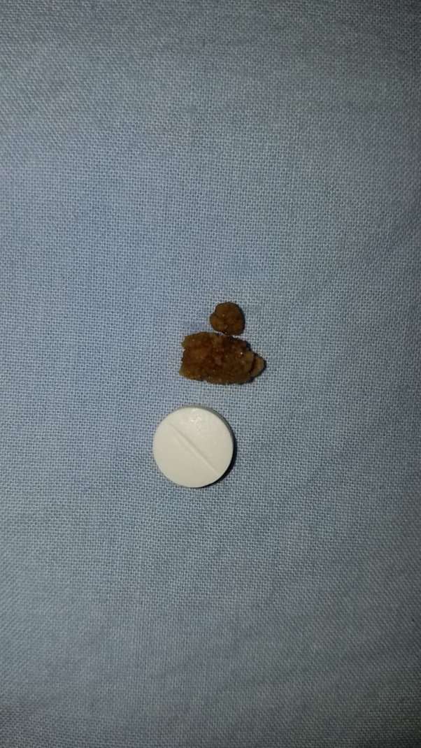 Grab Kidney Stone 5Mm You Must Know