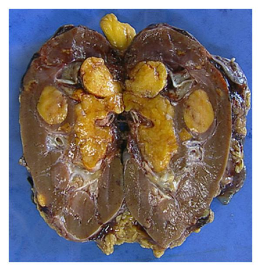 Gross specimen of right kidney with fatty sinusal tumor ...