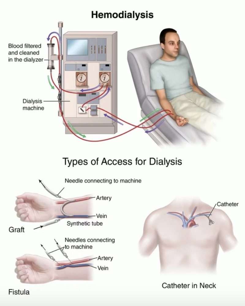 Guide: Life Insurance For Dialysis Patients [No Medical Exam!]