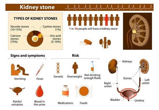 Helping Kids Avoid Kidney Stones