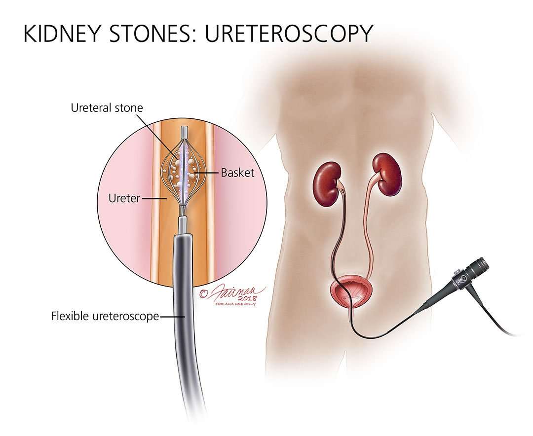 How are Kidney Stones Treated?