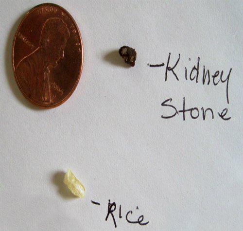 How Big 1 Mm Kidney Stone