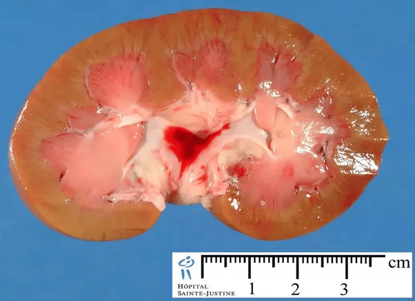 How do normal kidneys look like?