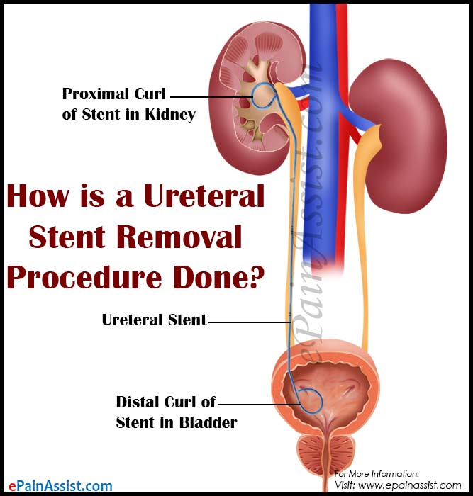 how do they remove a stent from your ureter mishkanet com