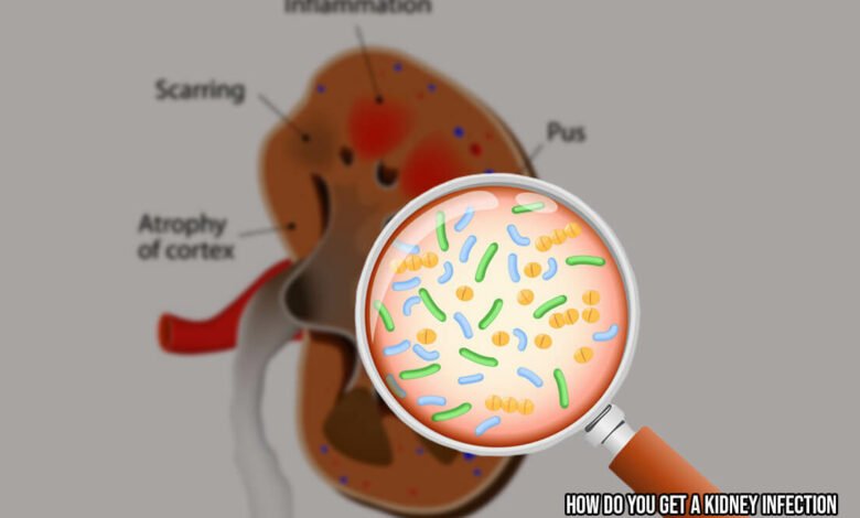 How do you Get a Kidney Infection: And How do you Treat a ...