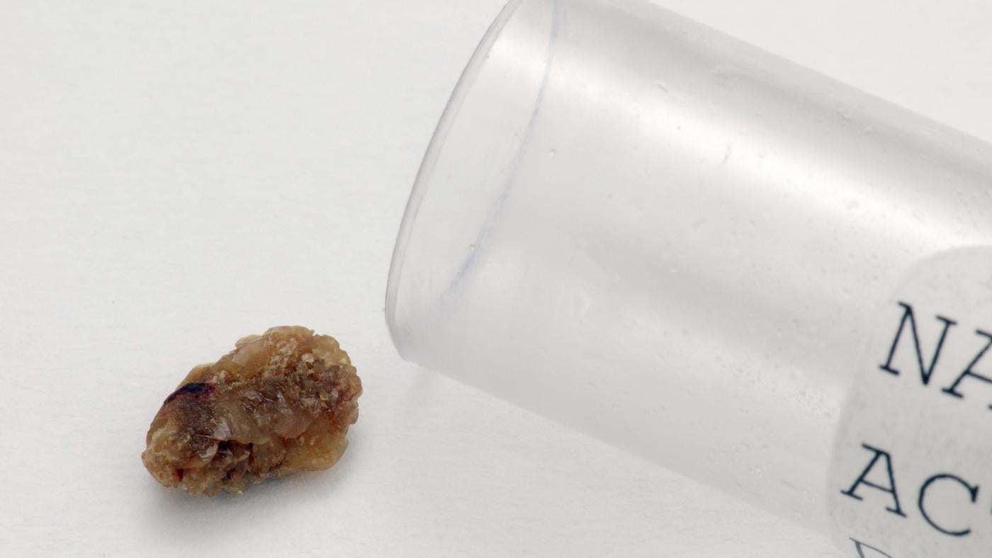 How Do You Know If You Are Passing a Kidney Stone ...