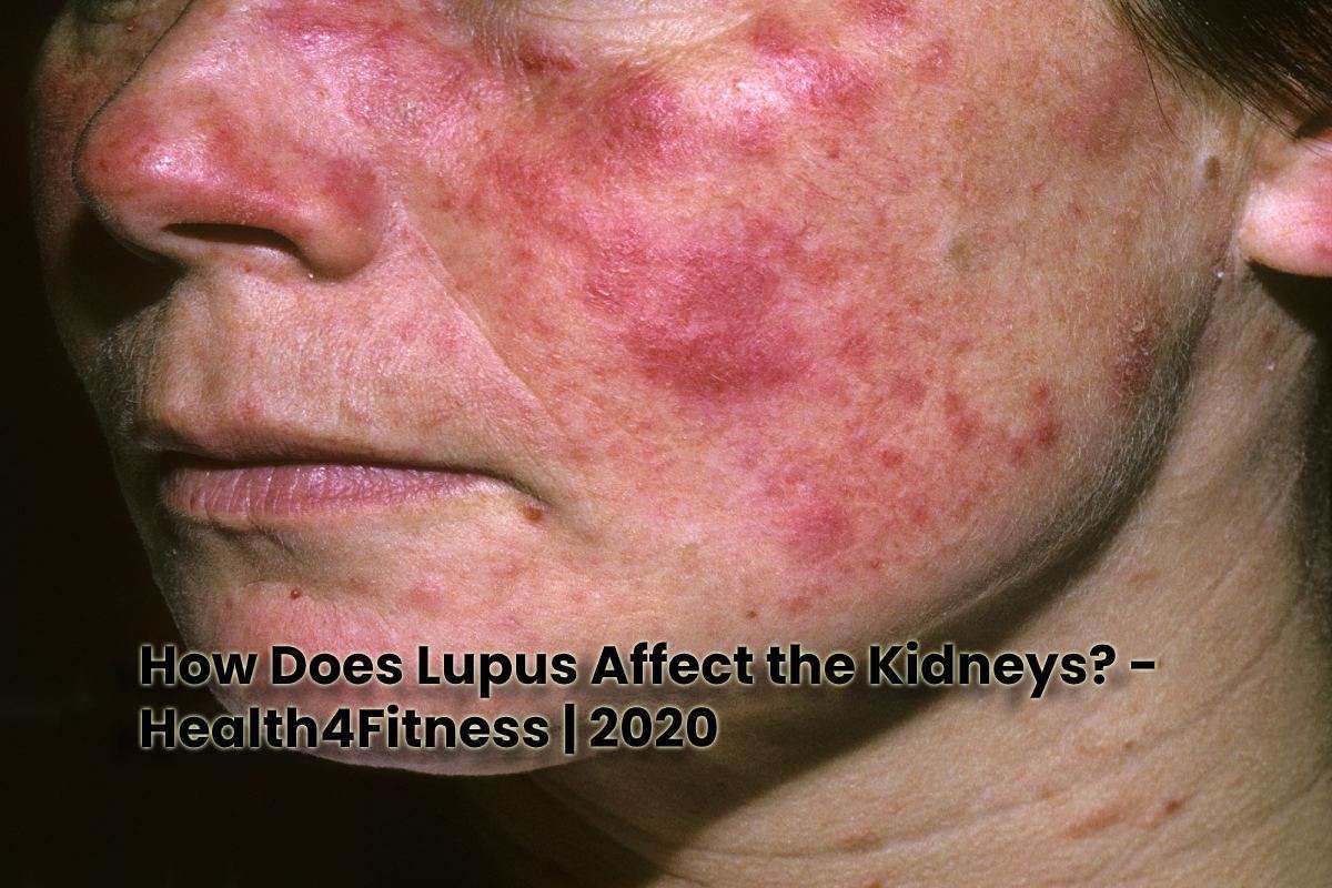 How Does Lupus Affect the Kidneys?