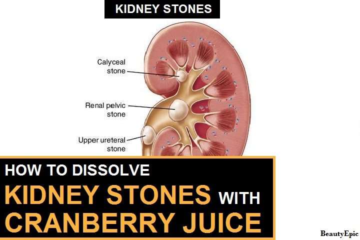 How Good is Cranberry Juice for Kidney Stones?