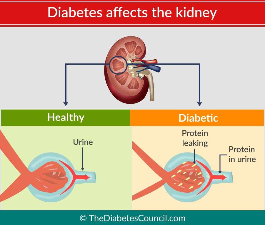 how-does-diabetes-affect-the-kidneys-healthykidneyclub