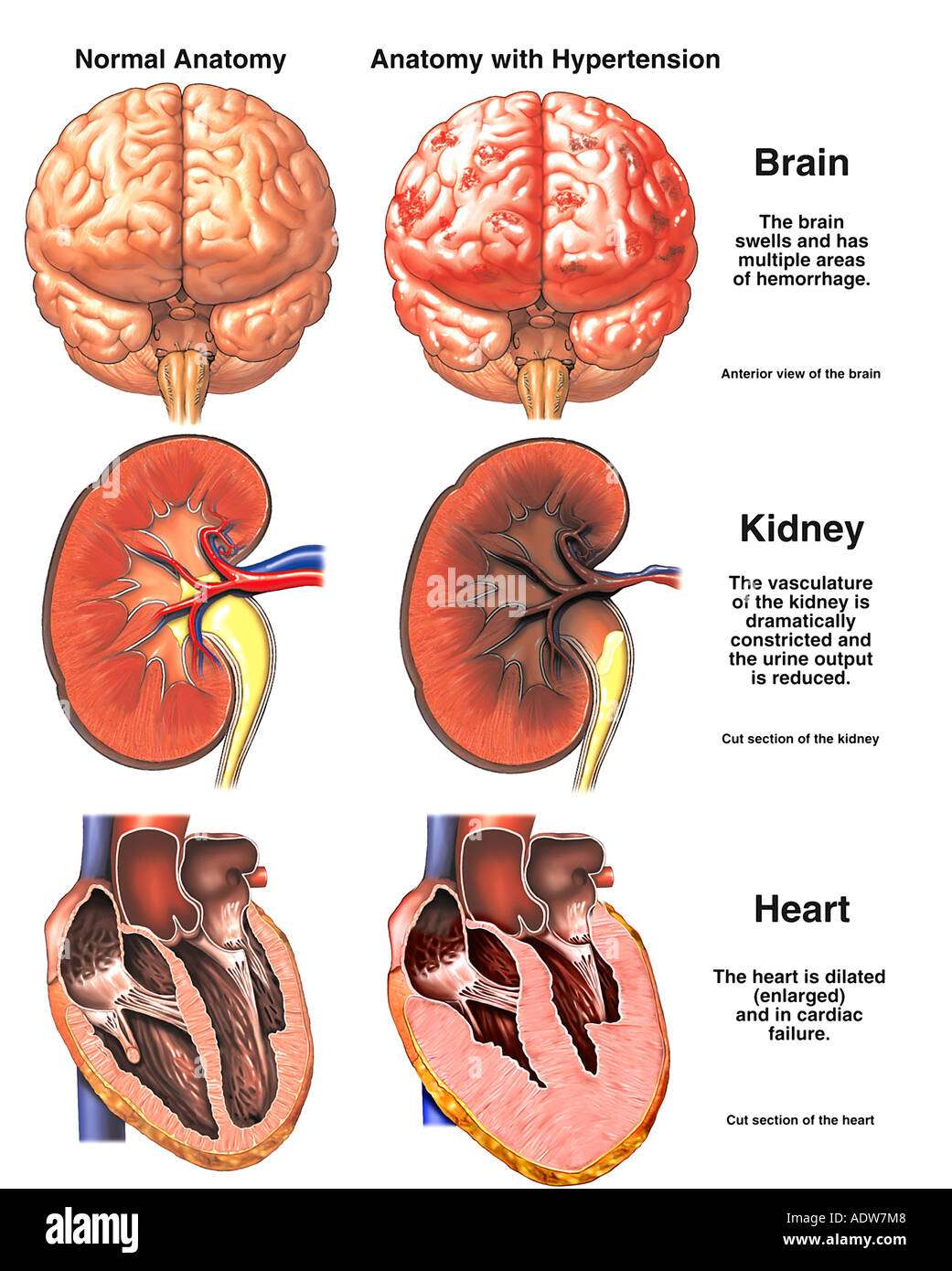 How High Blood Pressure Affects The Kidneys