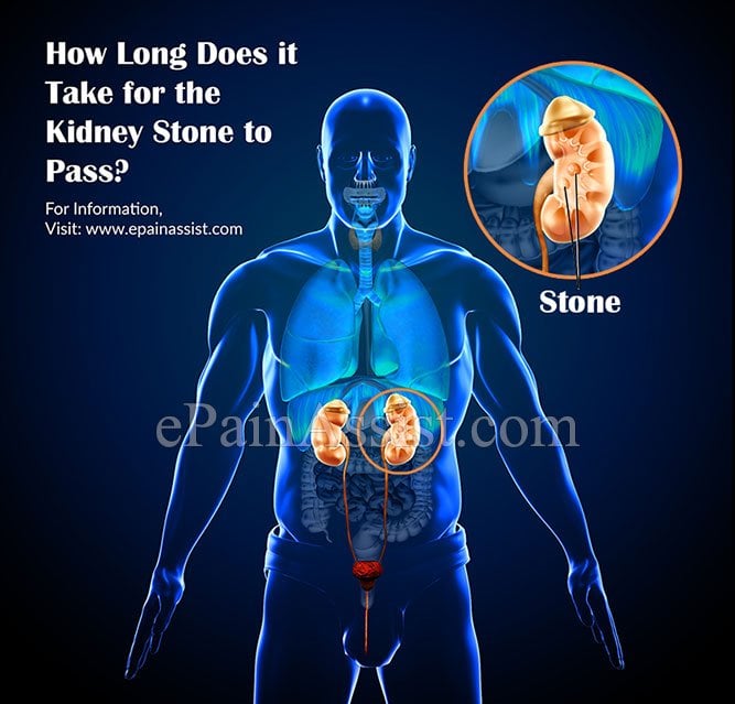 How Long Does it Take for the Kidney Stone to Pass?
