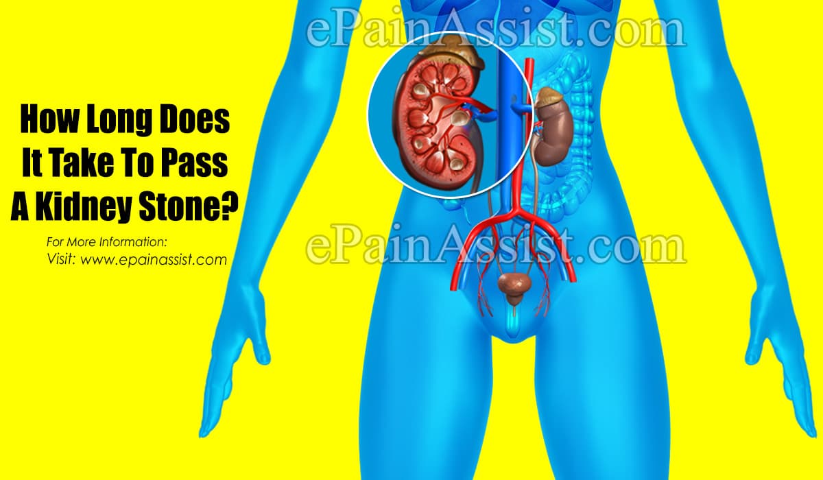 How long does it take to pass a kidney stone