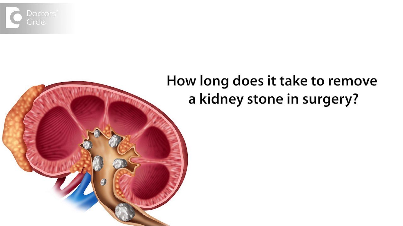 How long does it take to remove a kidney stone in surgery ...