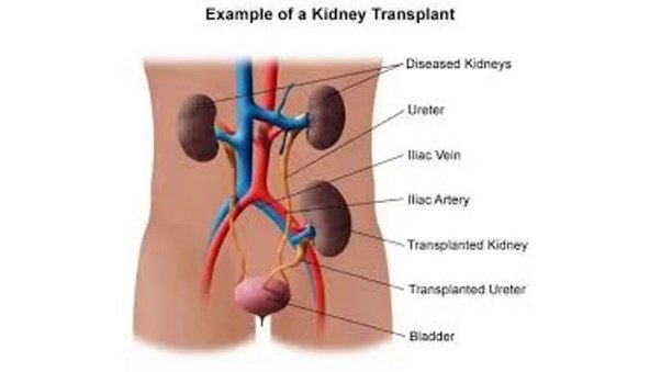 How much is a kidney transplant in the India?