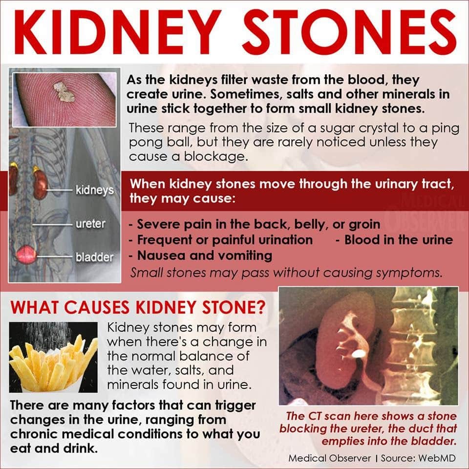 How To Dissolve Kidney Stones Naturally Without Surgery