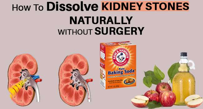 How To Dissolve Kidney Stones Naturally Without Surgery