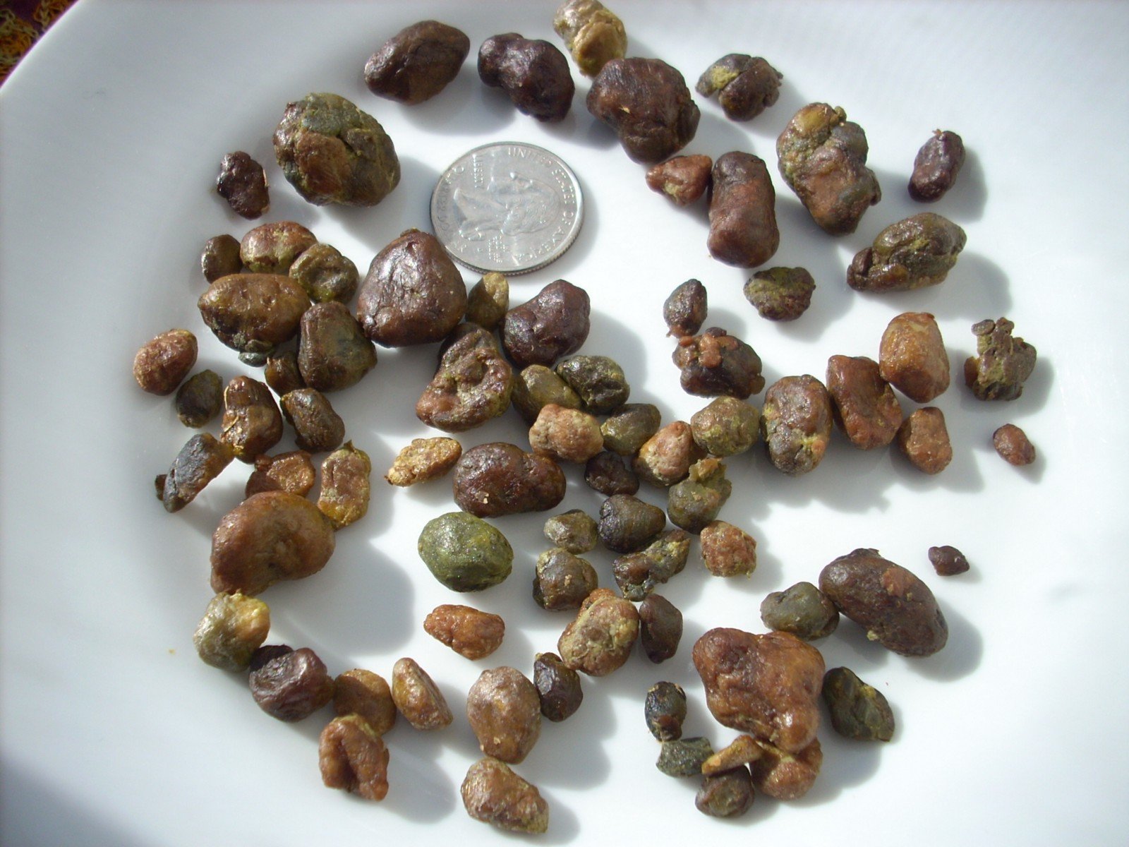 How to get rid of kidney stones naturally without surgery