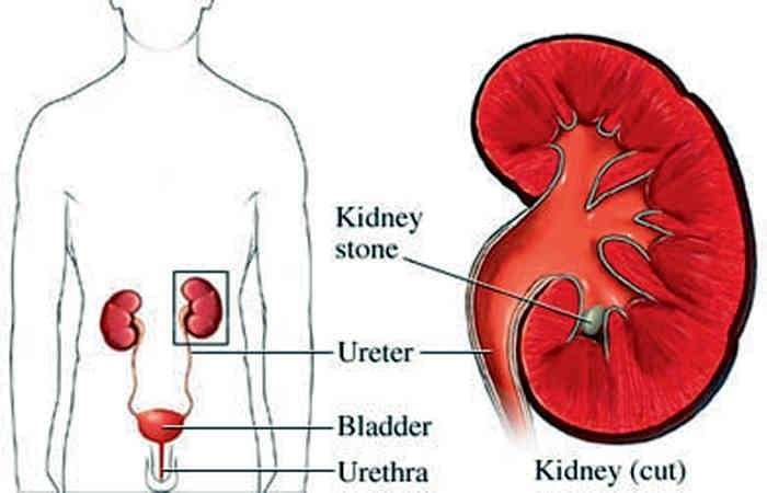 How To Pass Kidney Stone Stuck In Ureter