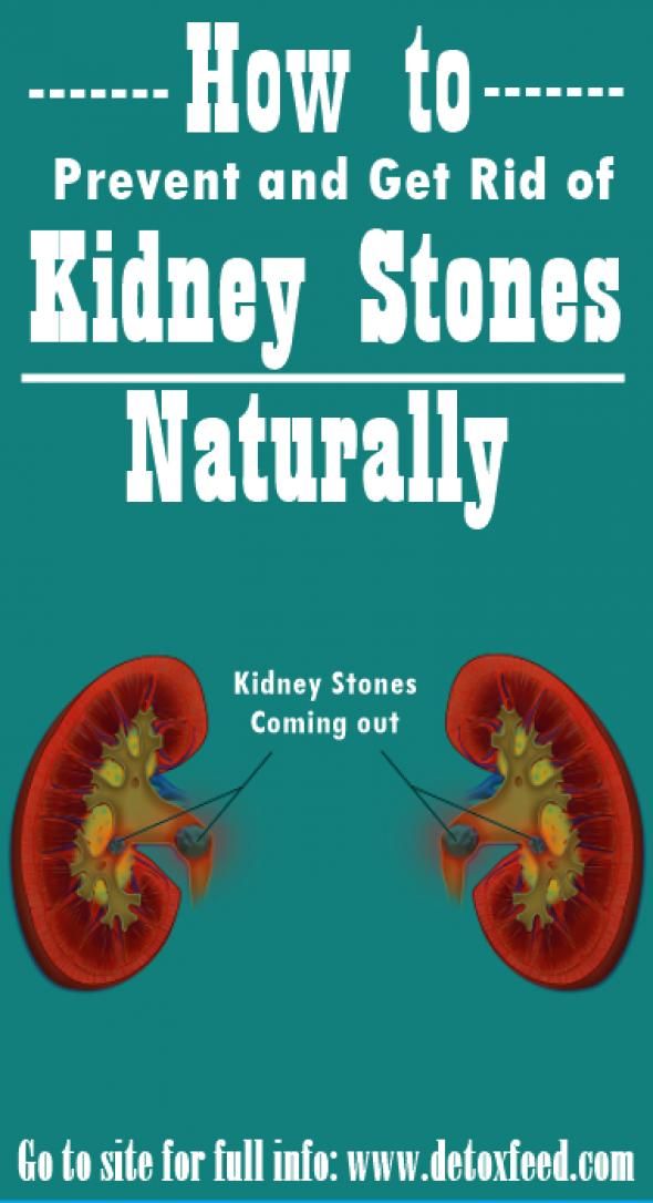 How to Prevent and Get Rid of Kidney Stones Naturally # ...