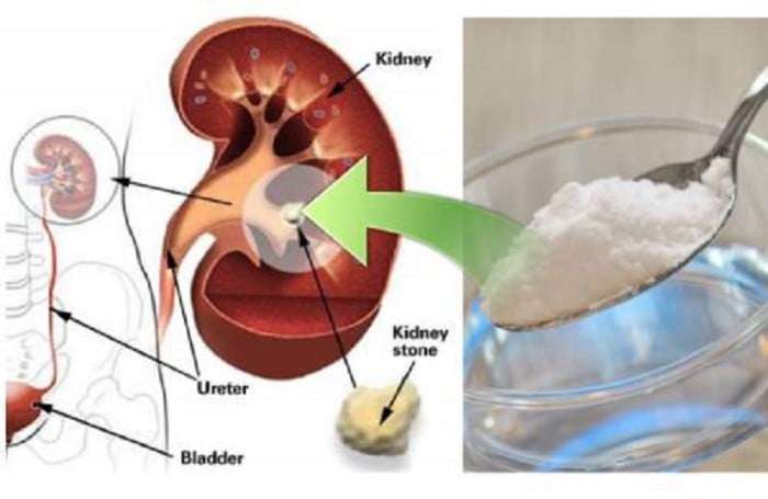 How To Repair Your Damaged Kidney With Only 1 Teaspoon Of Baking Soda ...