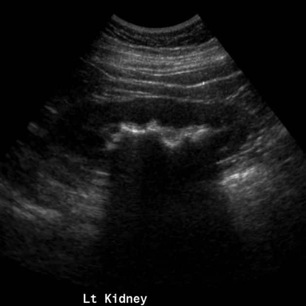 How To See Kidney Stones On Ultrasound