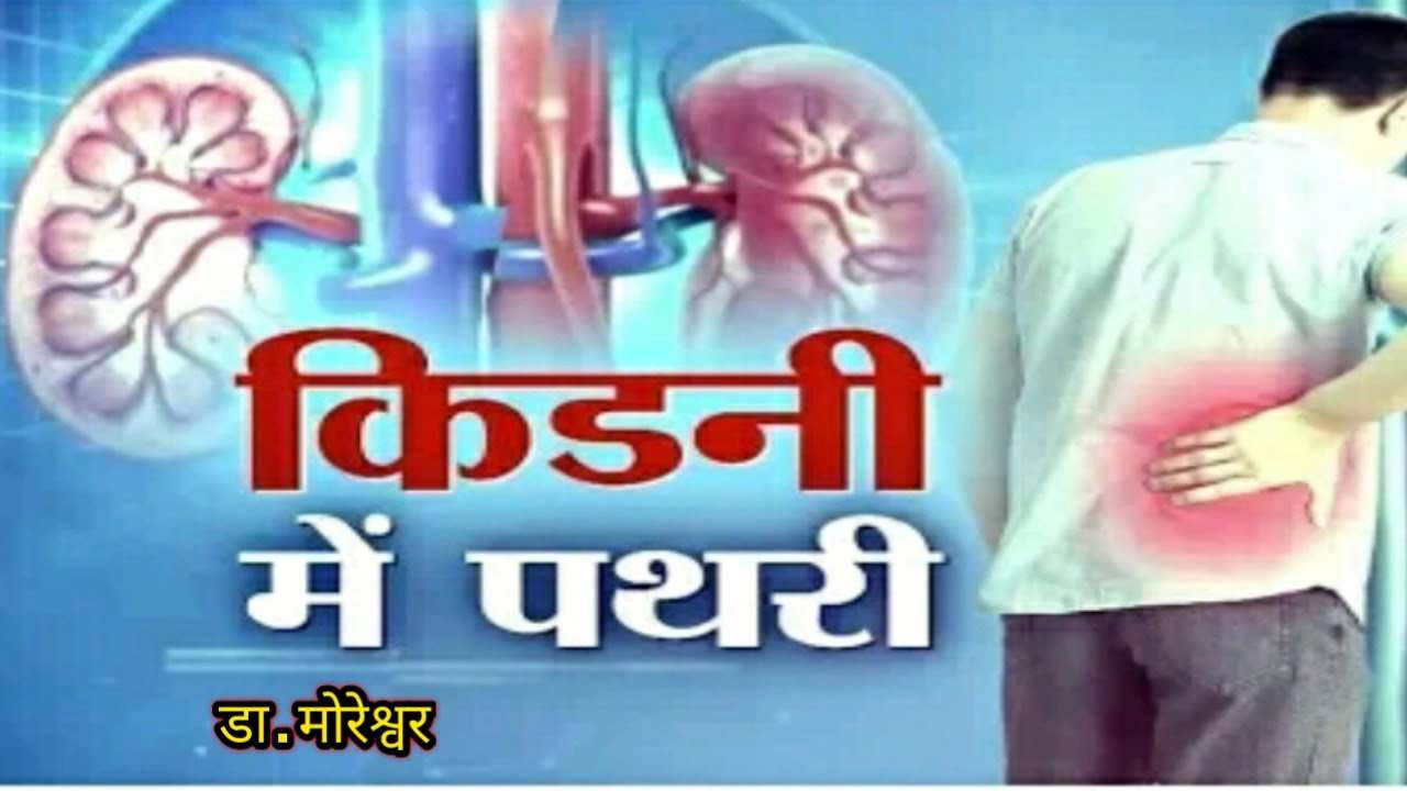 How to treat kidney stones   Dr.Moreshwer