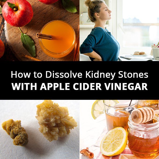 How To Use Apple Cider Vinegar To Treat Kidney Stones â ho.modulartz.com
