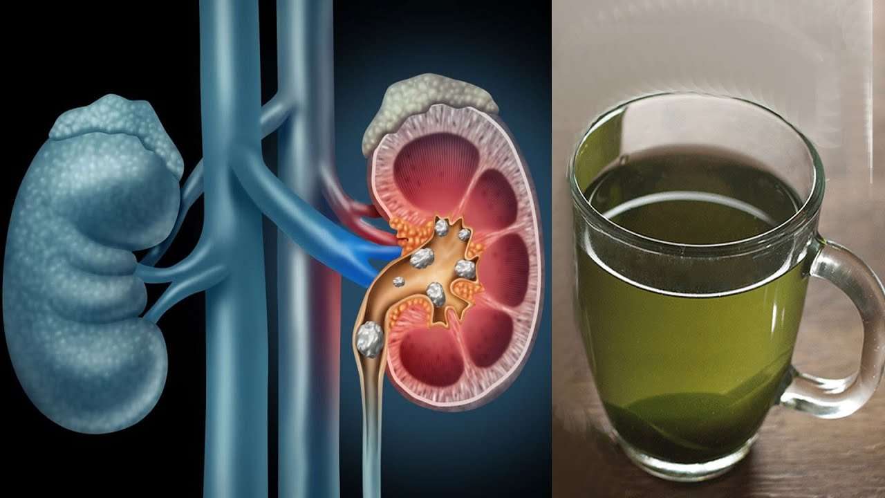 How to Use Chanca Piedra to Dissolve Kidney Stones Naturally Fast at ...
