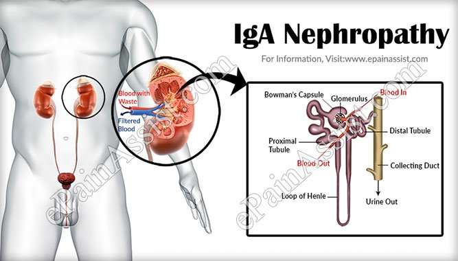 IgA Nephropathy or Bergers Disease
