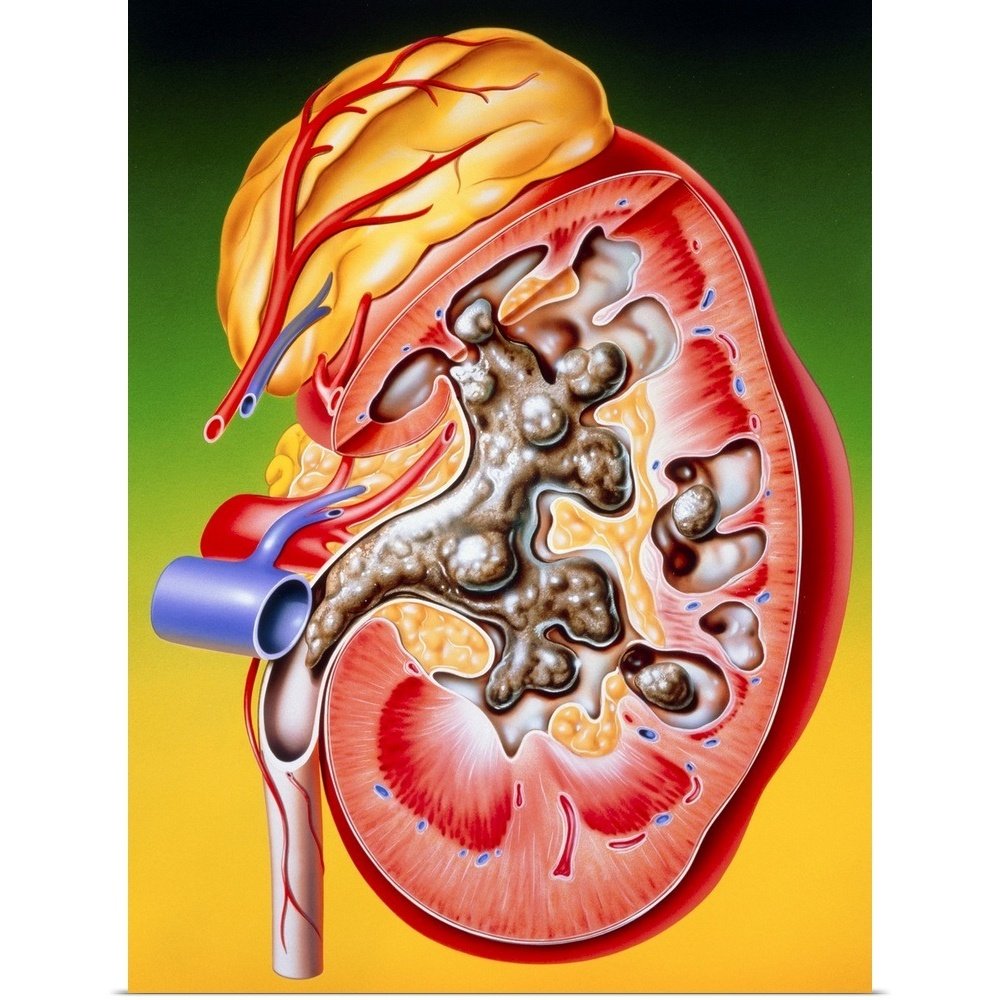 Illustration of a calculus or stone in the kidney Poster ...