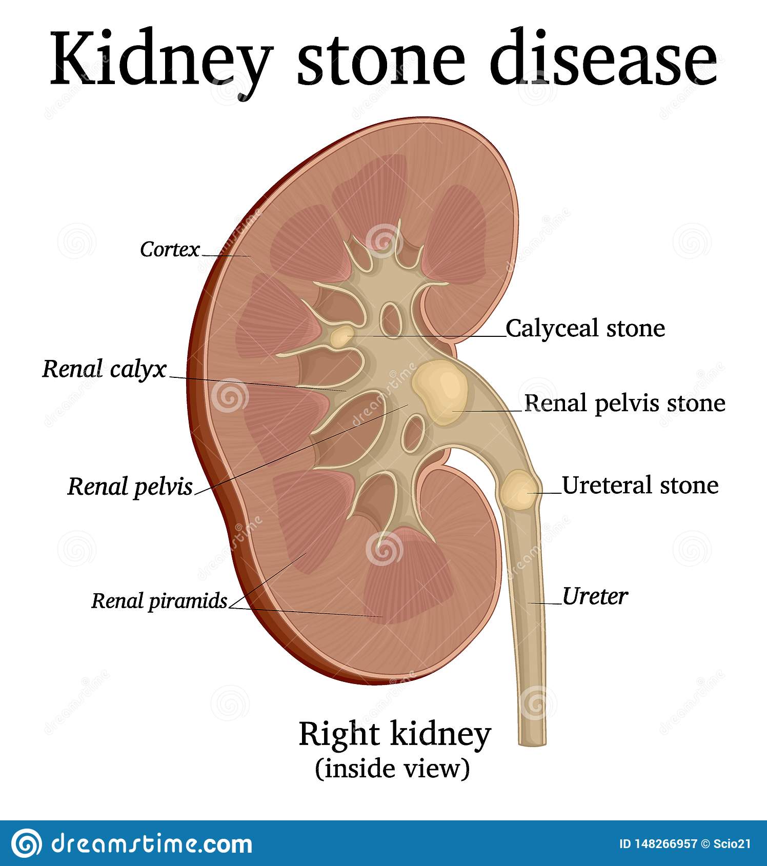 Illustration Of Kidney Stone Disease Stock Vector