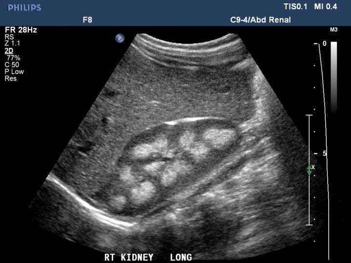 image of kidney stone on ultrasound