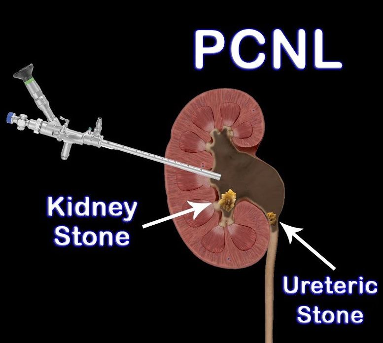 Impressive Info about Kidney Stones
