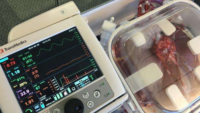 In Organ Transplants, Cooling Things Down May Not Be The Way To Go ...