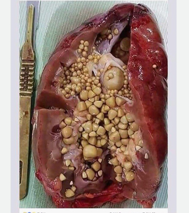 INSIDE THE KIDNEY OF A MAN THAT DRANK COCA