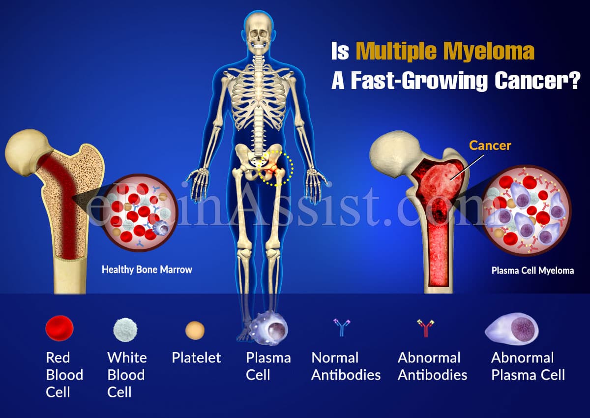 Is Multiple Myeloma A Fast