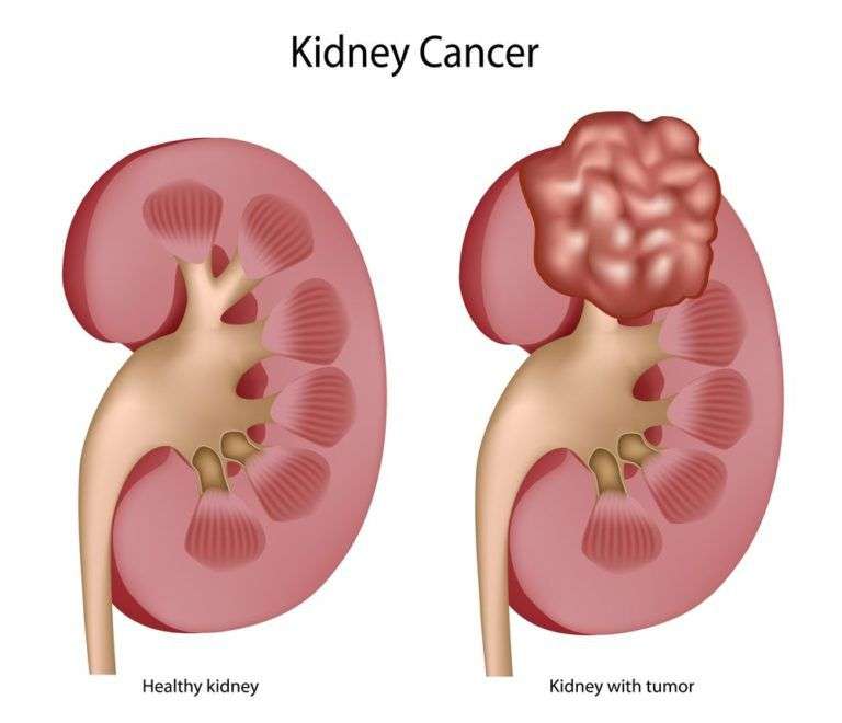 Kidney Cancer Â» Bradenton, FL