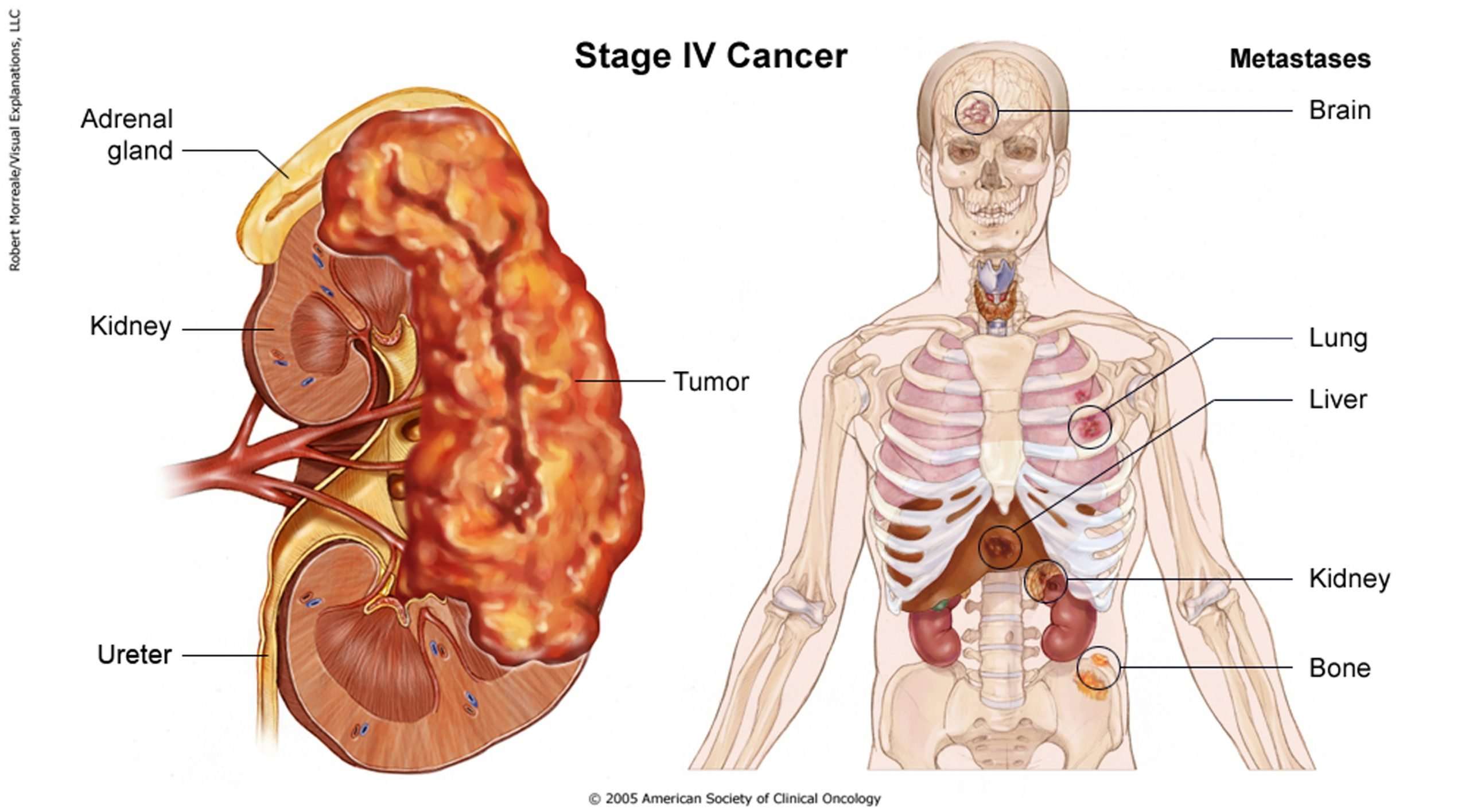 Kidney Cancer (Stage IV)