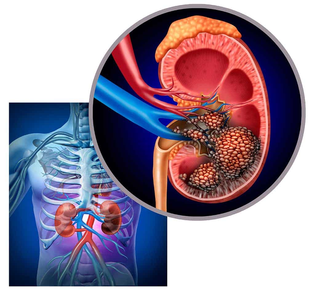 Kidney cancer: symptoms, diagnostics and treatment options