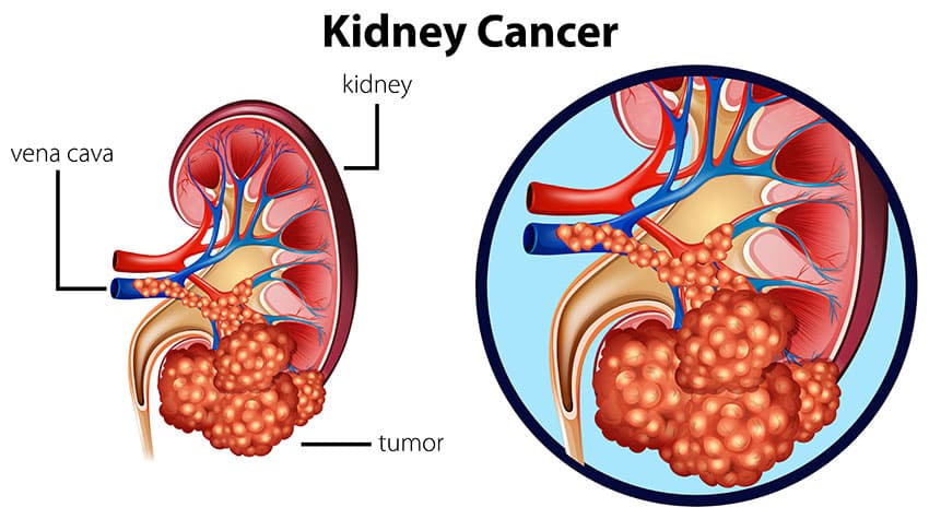 Kidney Cancer Treatment in Pune