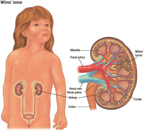 Kidney Cancer, What are the kidneys?, What is wilms