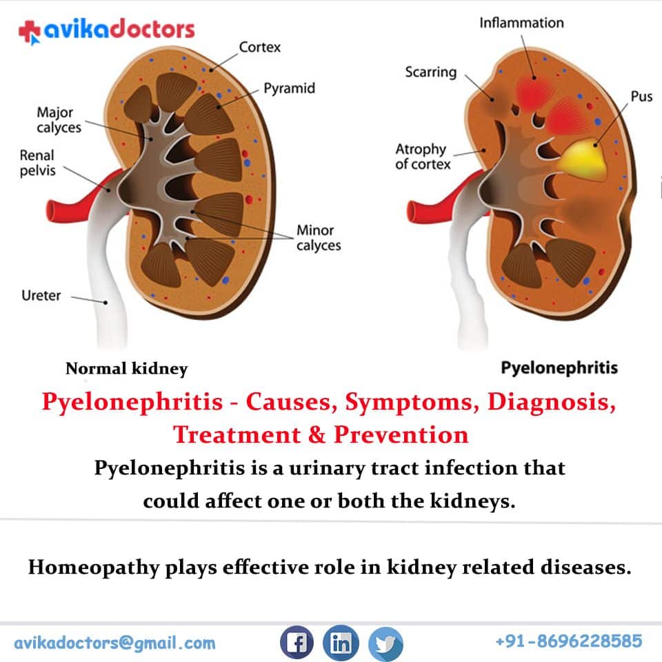 what-are-the-symptoms-of-cysts-on-the-kidneys-healthykidneyclub