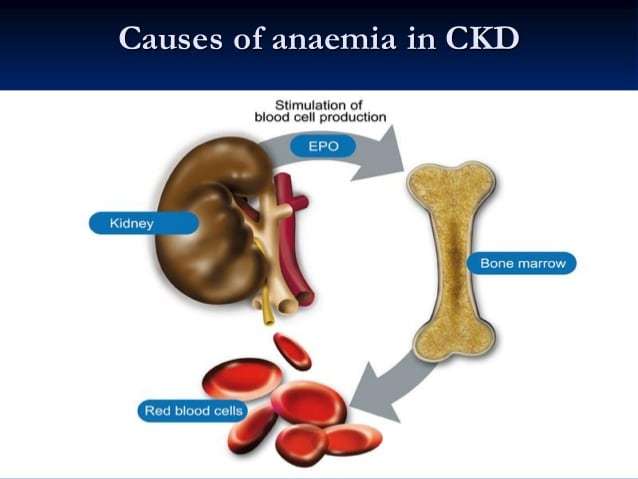 Kidney Disease Causing Anemia