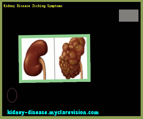 Kidney Disease Itching Symptoms 115849