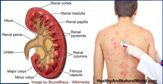 Kidney Failure And Itching Treatment