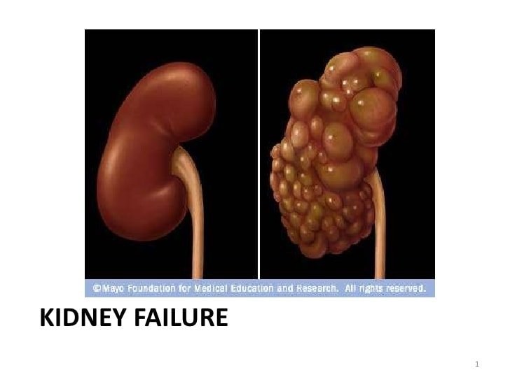 Kidney failure